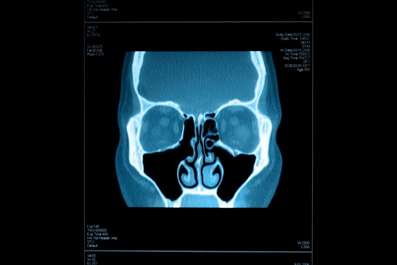 5 Reasons You May Need a CT Scan of Your Sinuses