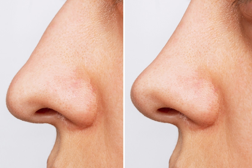 Noncosmetic Reasons to Get a Rhinoplasty